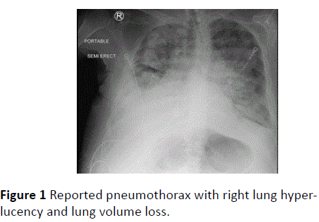 A Bairaƒa A A A A S Crushing Hug An Unusual Cause Of Pseudo Pneumothorax Insight Medical Publishing