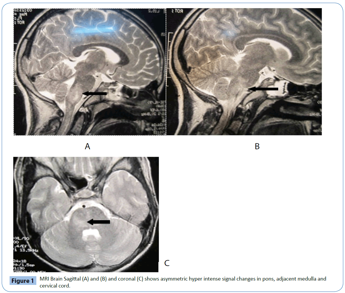 Acute Disseminated Encephalomyelitis A Rare Complication Of Dengue Infection Insight Medical Publishing